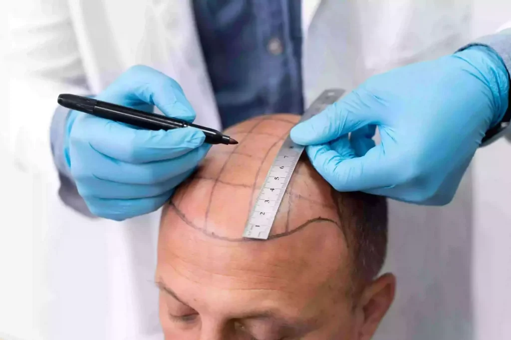 hair line design by experienced hair transplant surgeons in Indore
