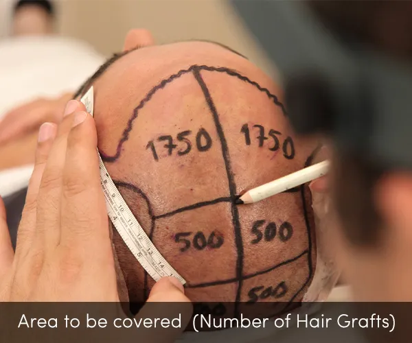 how many hair grafts are required in hair transplant understand