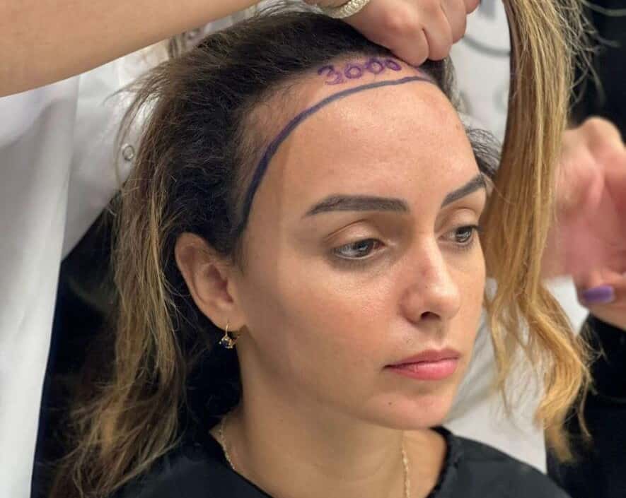 female hair transplant in indore, female hair transplant doctor in indore