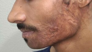 beard hair transplant procedure in indore, beard transplant in indore