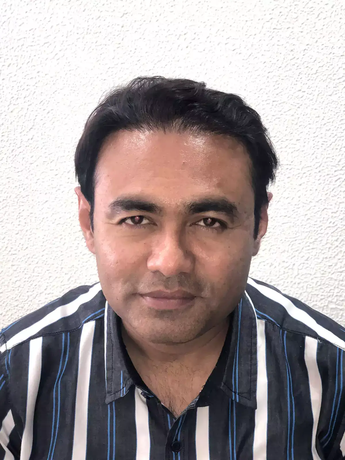 hair transplant result with new hair line