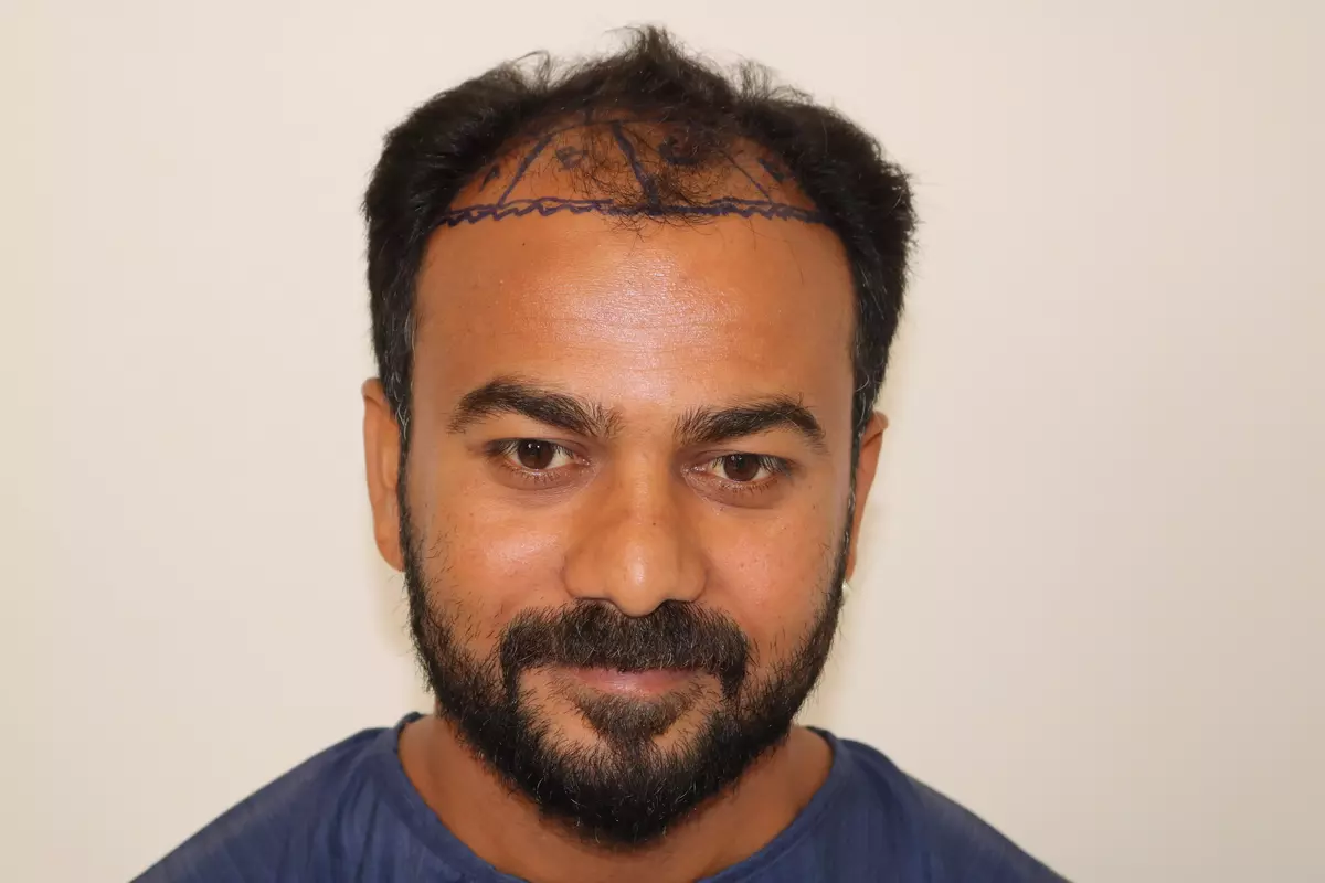 hair transplant in patient from nigeria at seraphic hair transplant indore