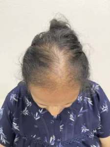 diffuse female pattern hair loss, female hair transplant doctor in indore.