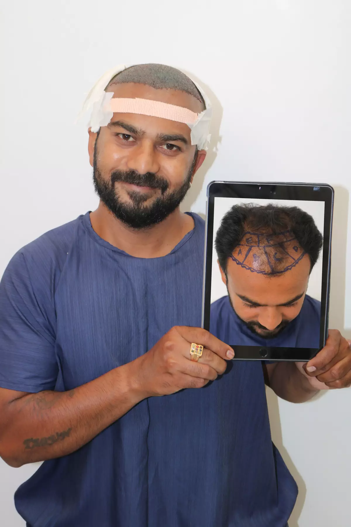 Seraphic - hair transplant result