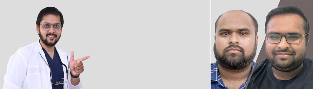 result hair transplant indore, best hair transplant in indore