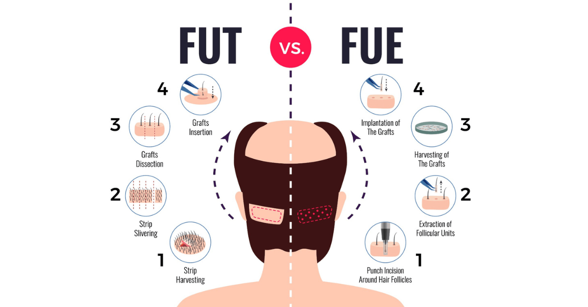 compare fue and fut hair transplant