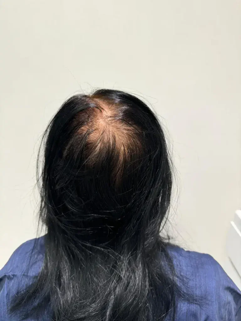 hair transplant in crown area for female patient by dr ankit khasgiwala at seraphic hair transplant indore