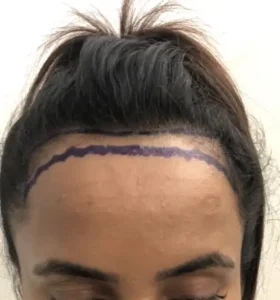 female hair line for women hair transplant in indore