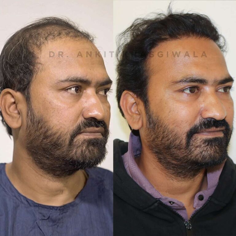 Growth after hair transplant