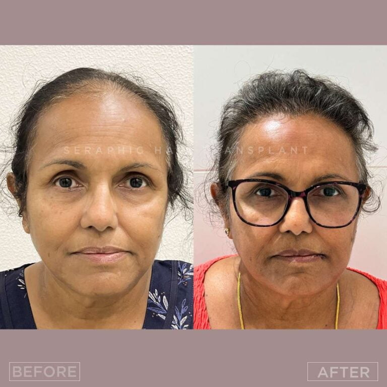 Untitled-psd bf-af (1)_10_11zon