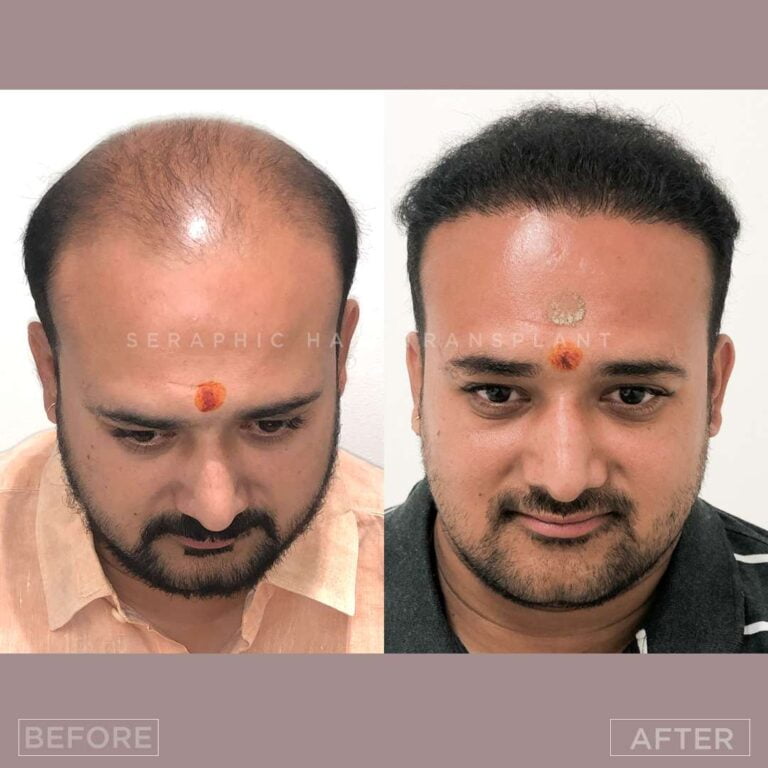 Untitled-psd bf-af (2)_11_11zon