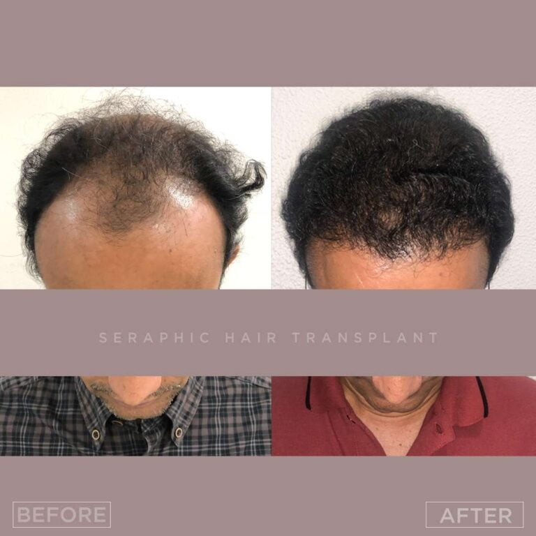 Untitled-psd bf-af_12_11zon