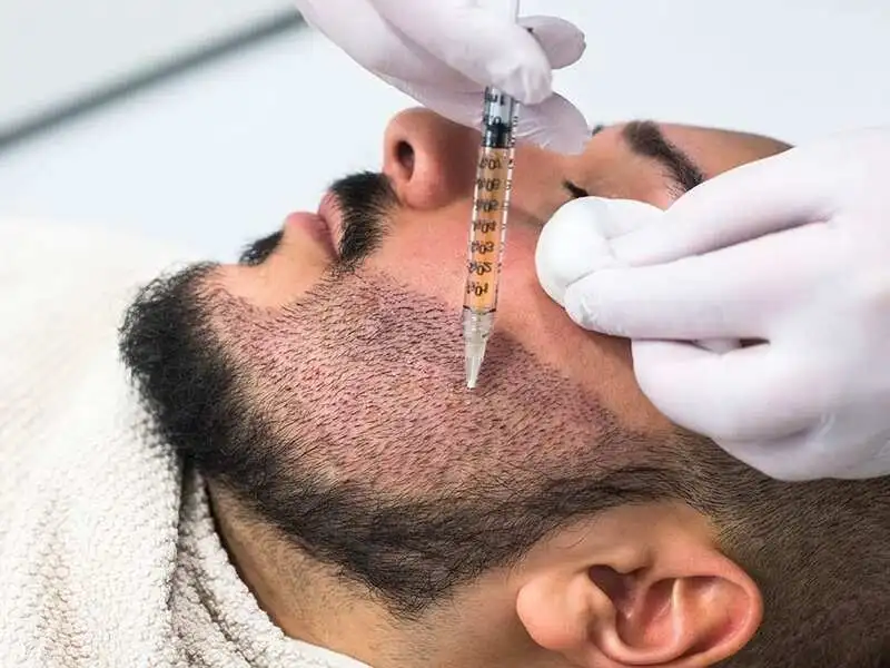 beard hair transplant