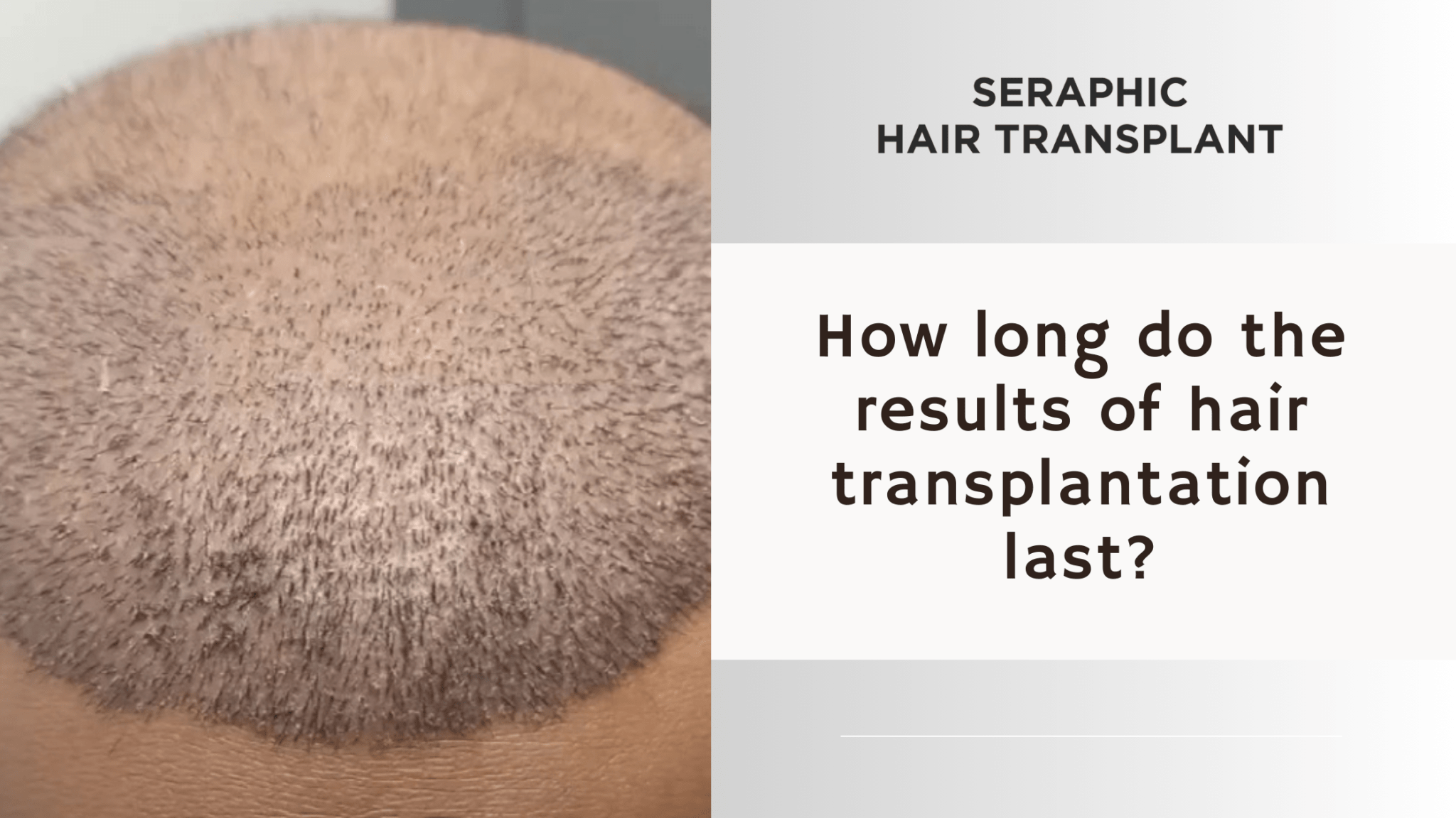 Hair Growth Phases After a Transplant