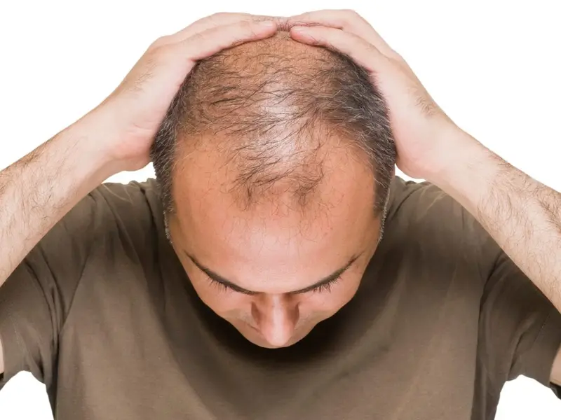 hair transplant cost