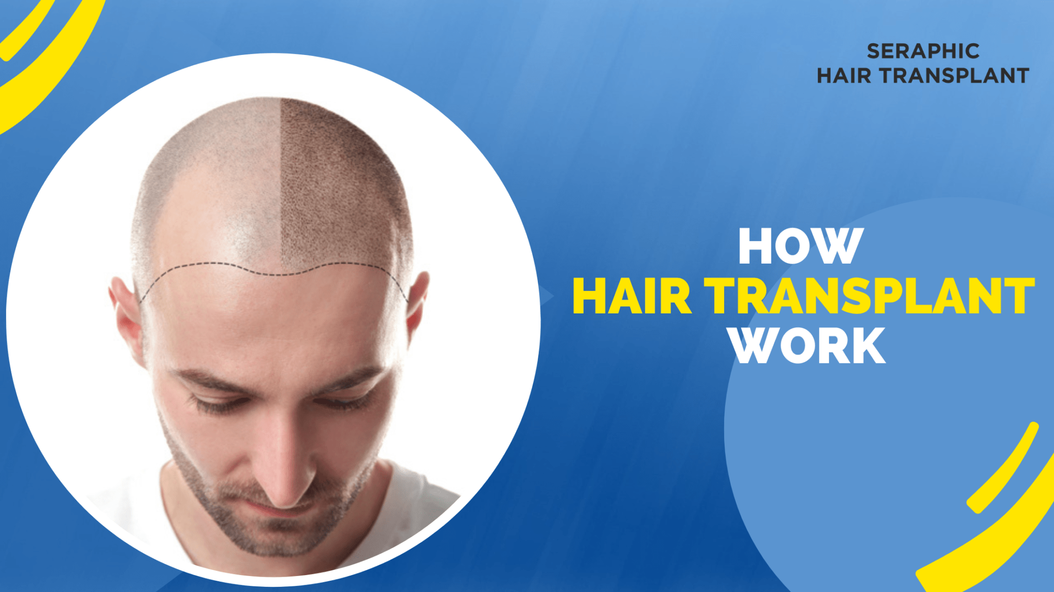 how hair transplant work