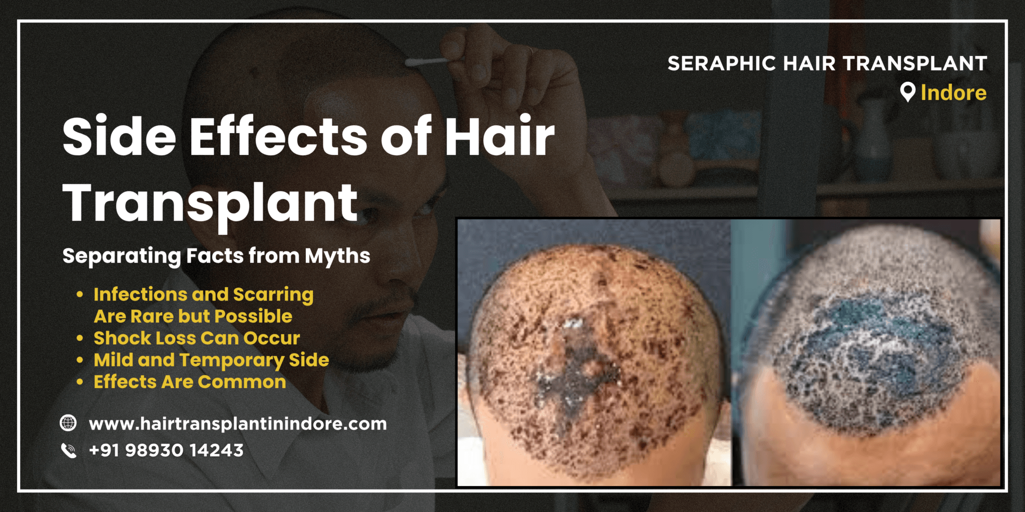 side-effects-of-hair-transplant