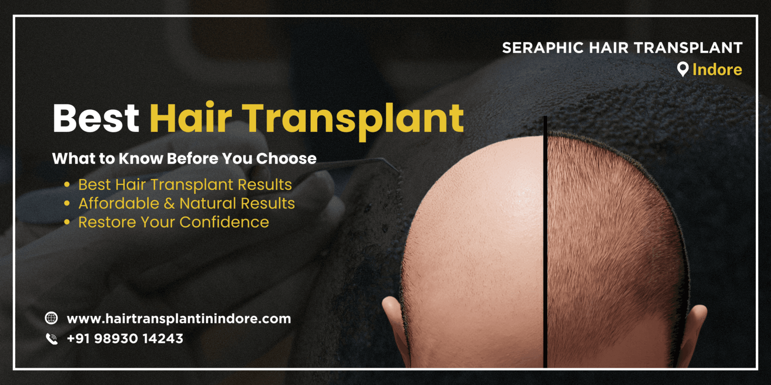 best-hair-transplant