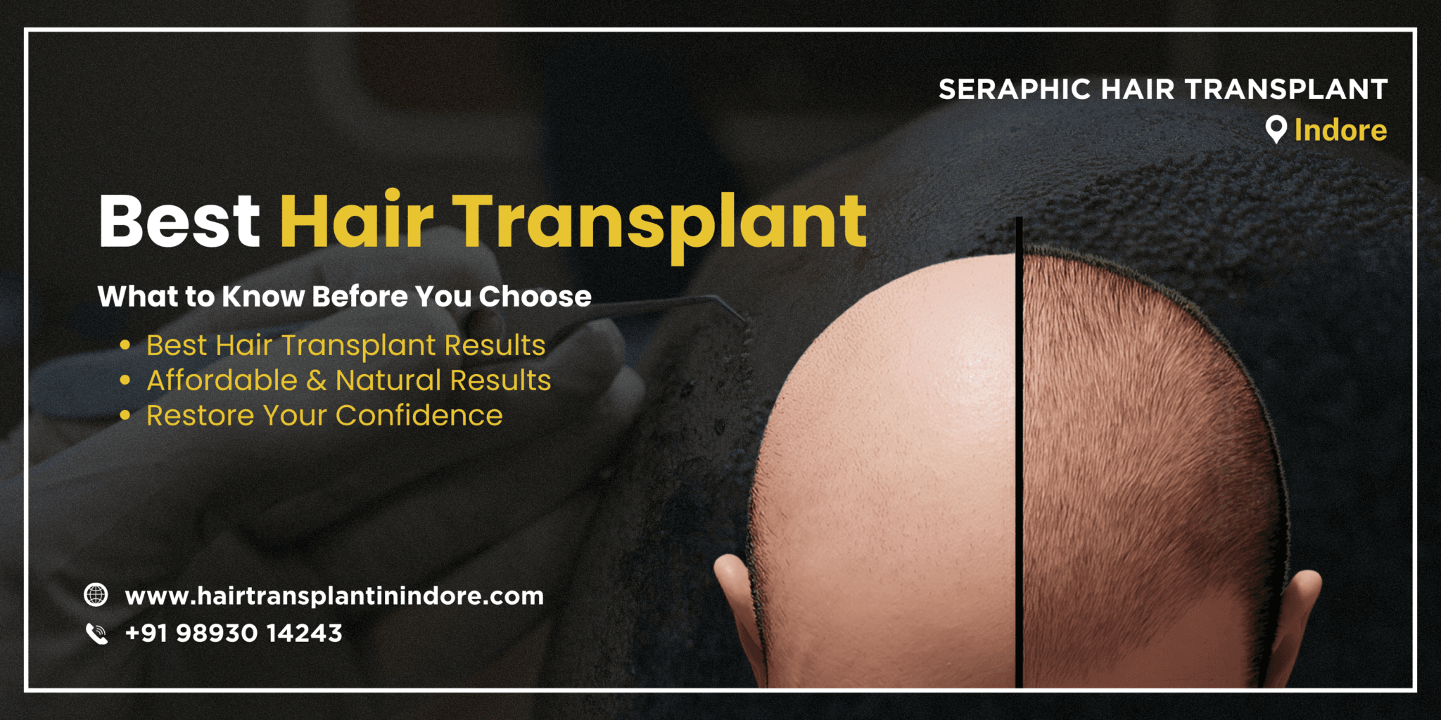 best-hair-transplant