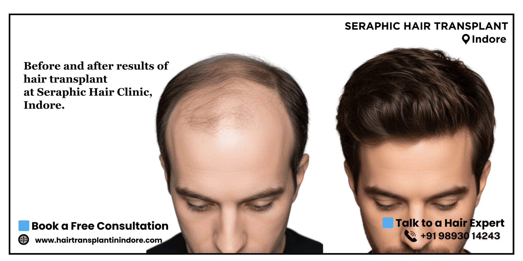 Best-Hair-Transplant-in-Indore