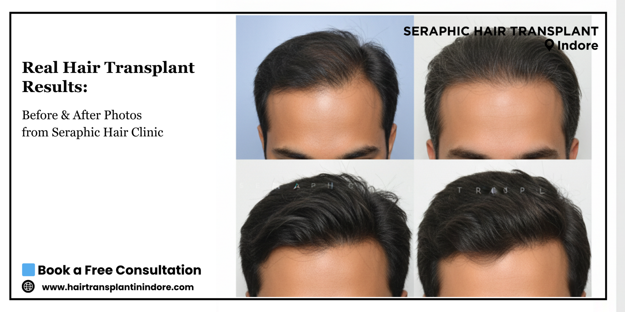 Real Hair Transplant Results_ Before & After Photos